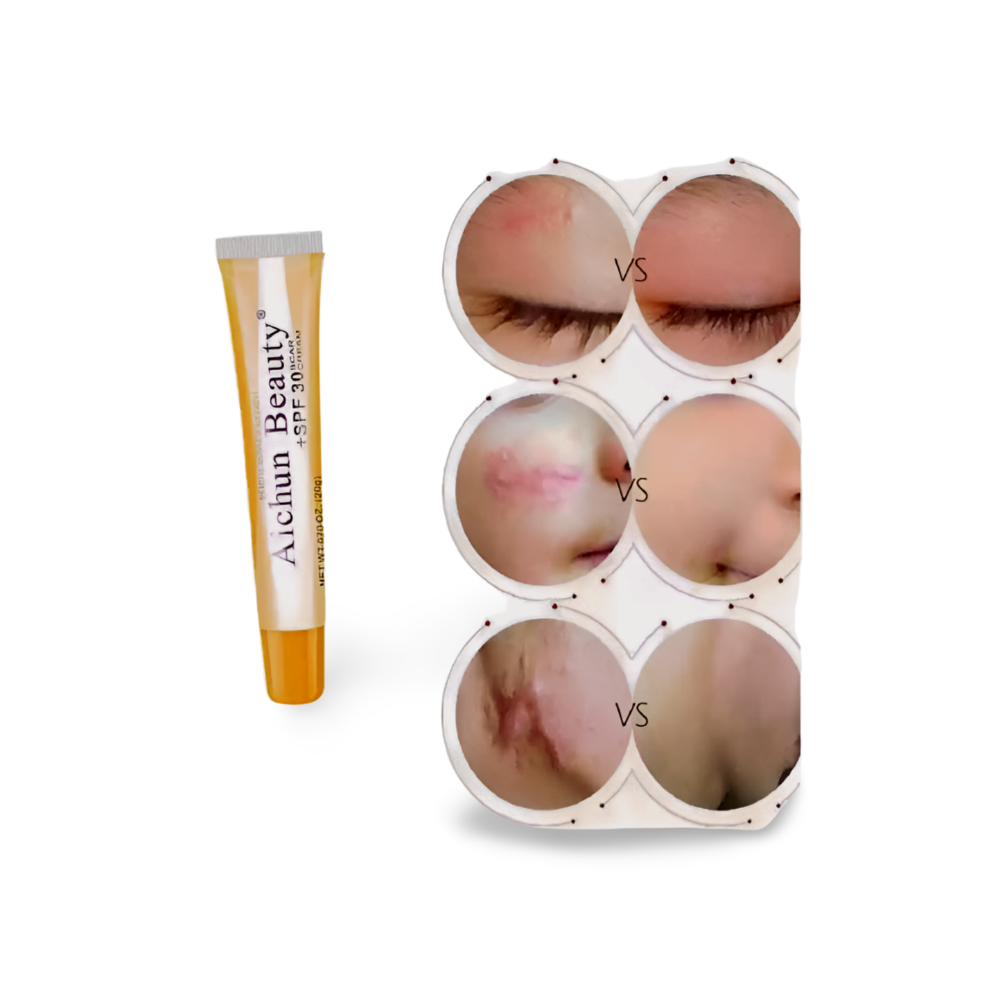 Aichun Beauty Scar Cream